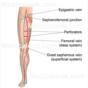  Psychological Impacts Of Spider Veins