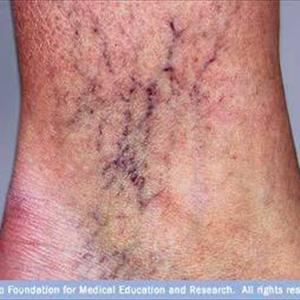 Vericose Vein Treatment 