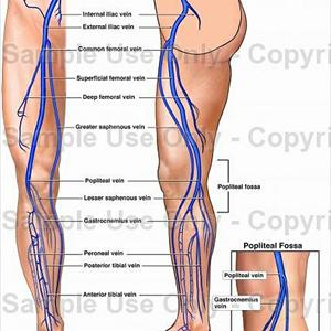 Spider Vein Solutions 