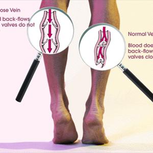  A Review Of Laser Treatment For Varicose Veins