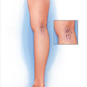 Define Varicosities - Put An End To Your Fear Of Varicose Veins