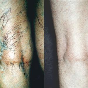  Home Remedies For Varicose Veins Treatment