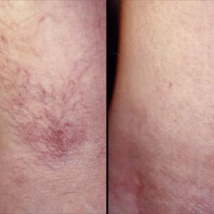  Finally Getting Rid Of Spider Veins