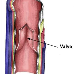 Menopause Varicose Veins 