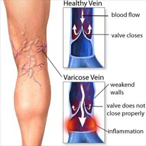 Varicose Eczema Support - More Quack Cures For Varicose Veins