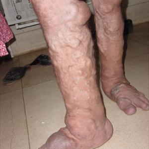 Closure Varicose Veins 