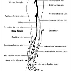 Varicose Veins Toronto 